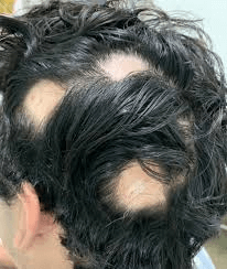o tônico capilar não pode resolver alopecia.
